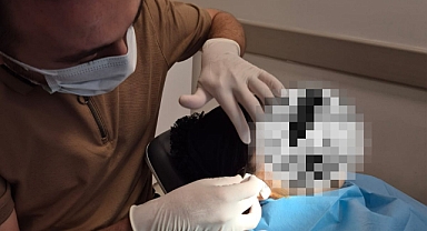 Çene Eklemi Çıkığına Yenilikçi Tedavi