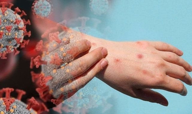 MAYMUN ÇİÇEĞİ ALARMI!