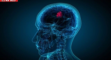 Geçmeyen Baş Ağrısı Ölümcül Haberciniz Olabilir!