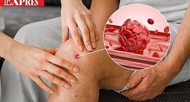 Modern Çağın Görünmez Katili: Tromboz Türkiye’de Can Alıyor